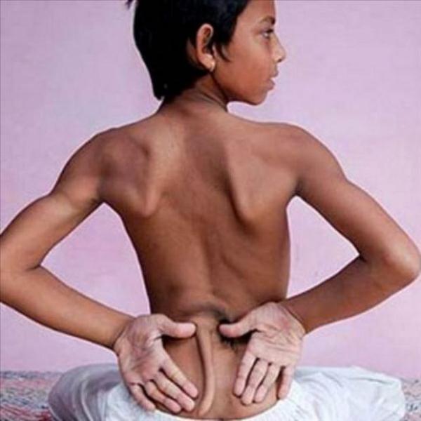 Aynı hastalıkla dünyaya gelen Hintli 12 yaşındaki Chandigarh ise sıradışı özelliği yüzünden rüya gibi bir hayat yaşıyor. Hindistan’da yaşayan tanrı ilan edilen Arshid’e Balaji adı verildi