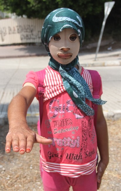 Savaş Mağduru Kız Çocuğu Maskeyle Yaşıyor